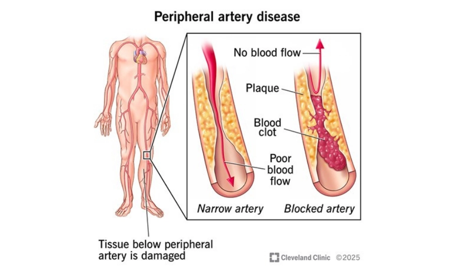 Periferik Arter Hastalığı (1)