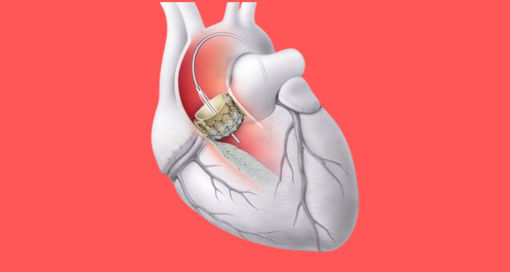 kapak rahatsızlıkları 3